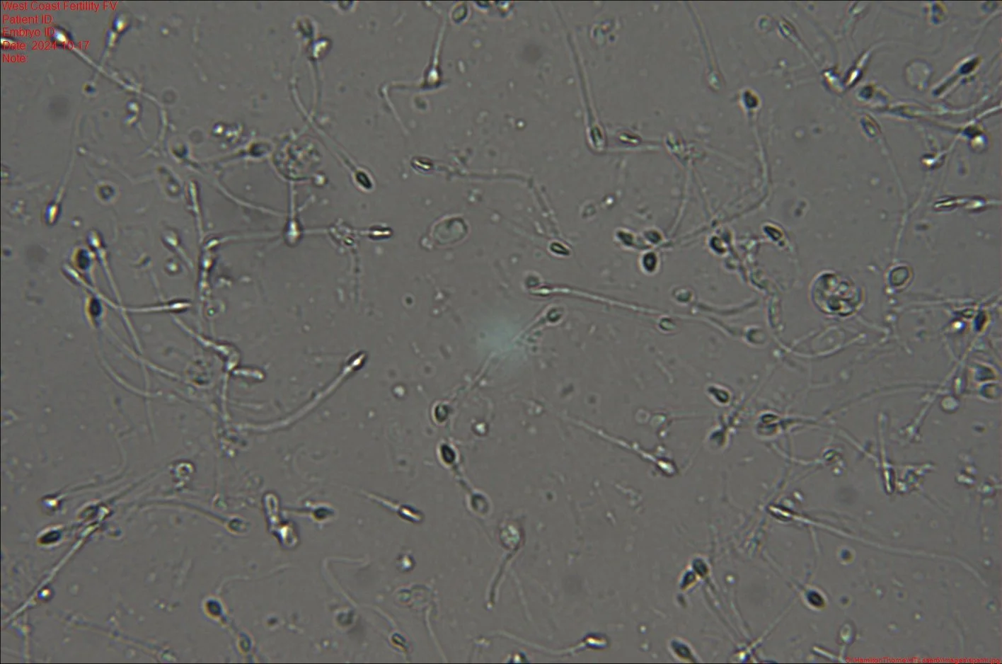 Microscopic view of numerous sperm cells with elongated heads and long tails, floating on a light background.