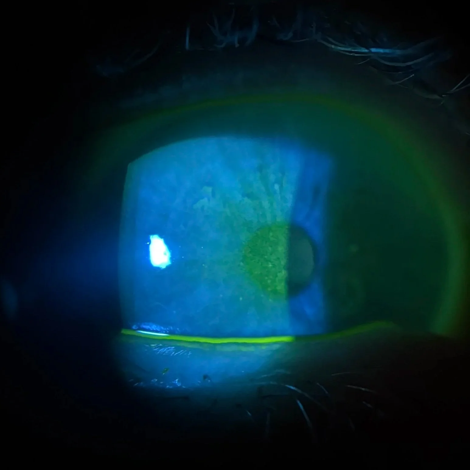 Dry Eye
