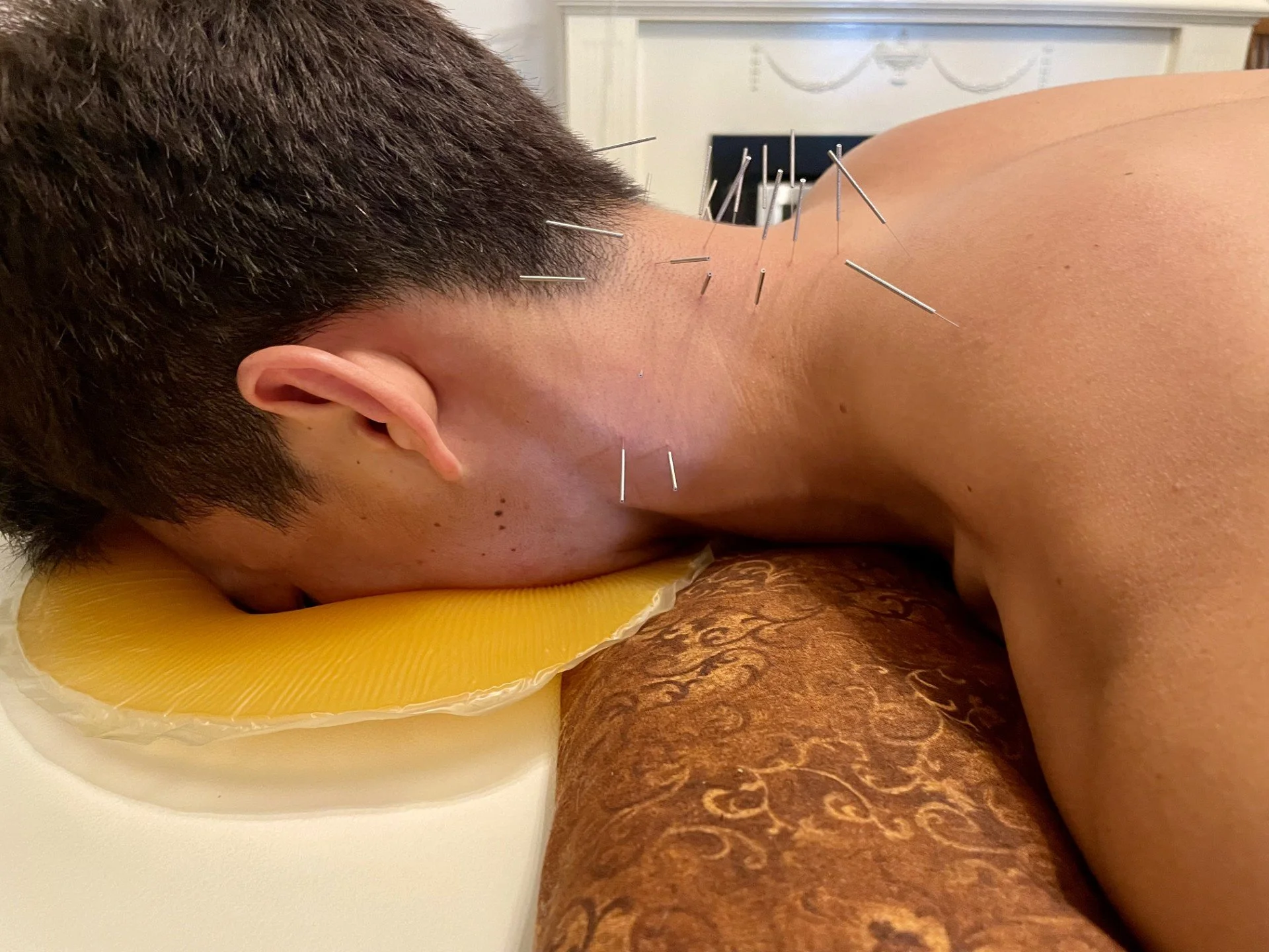 acupuncture treatment for neck pain in Adelaide
