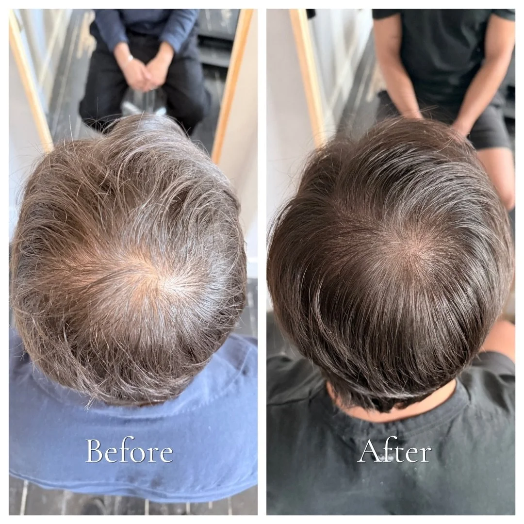 Left: no SMP
Right: after 2 sessions.

This client came in wanting something conservative and natural, not a dramatic change, just fuller looking hair. Session 1 was intentionally light, laying the foundation and giving him a chance to see how it hea