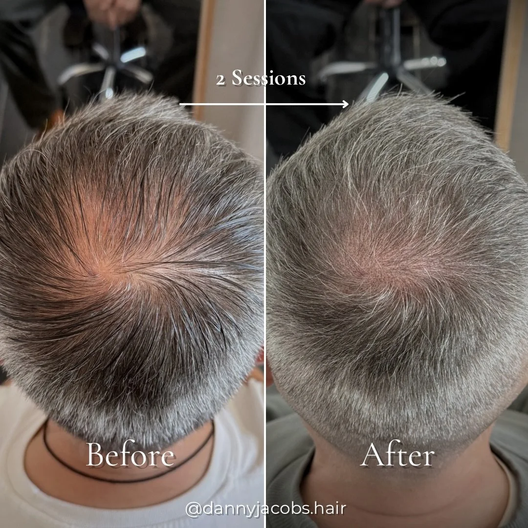 Before / After - 2 sessions.

Crown density SMP on a client with naturally grey hair. The goal was soft, natural looking coverage, nothing dramatic, just a fuller crown that still reads as his own hair.

Pigment is carefully matched to the individual