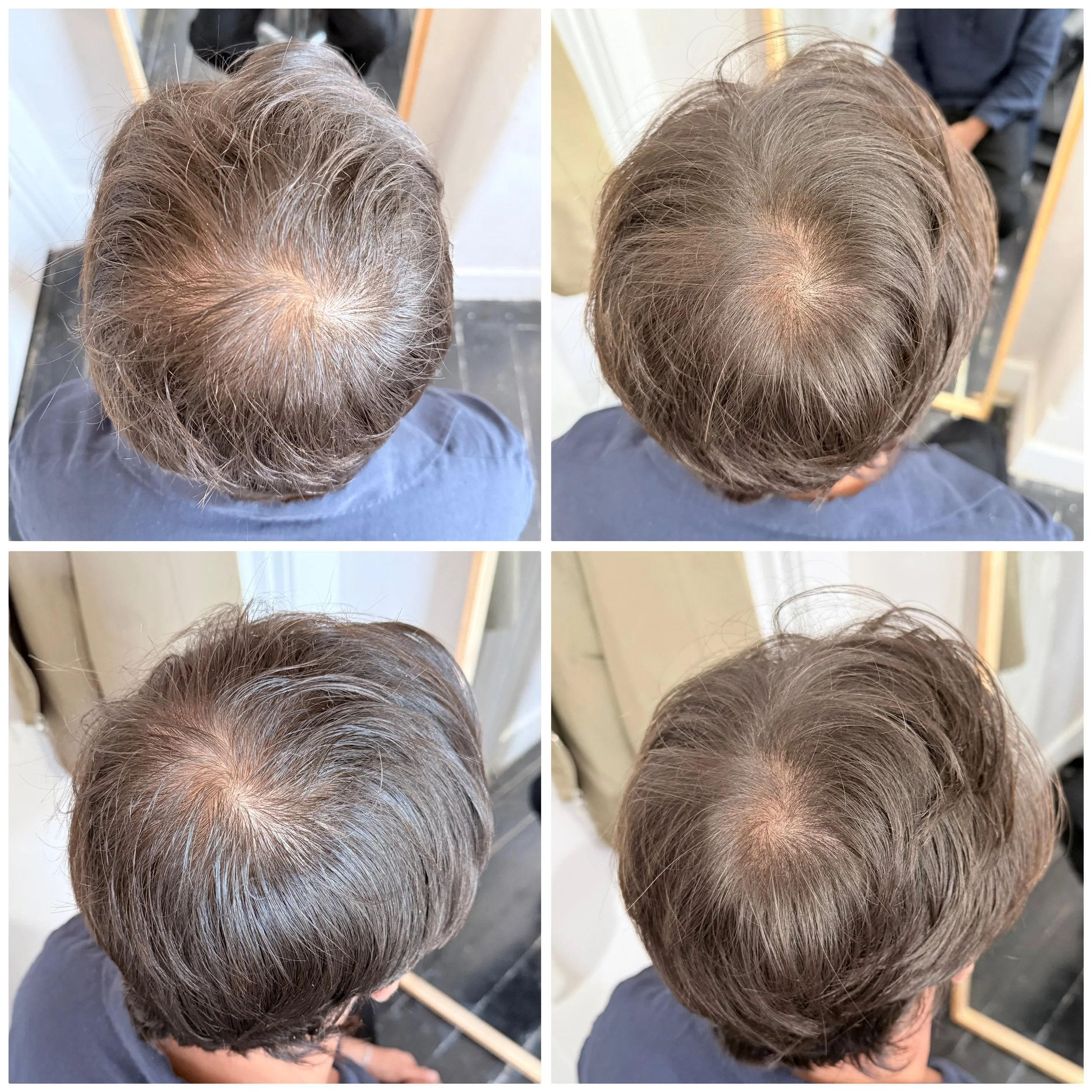 Before and after images of a person's scalp showing hair thinning on the left and improved hair density on the right.
