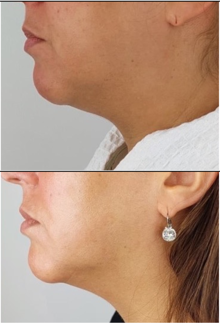 Zemits Friolift 2.PNG