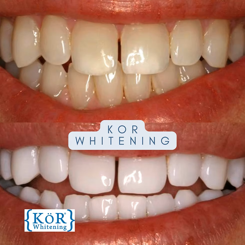 KoR whitening.png