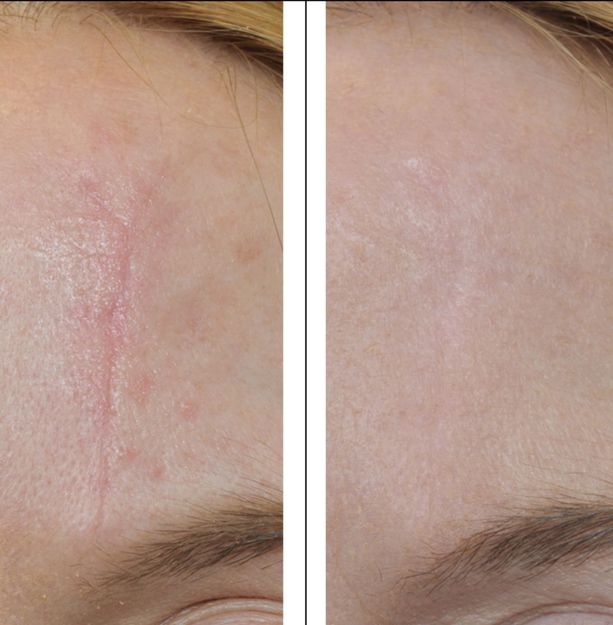 Scar revision 4b.PNG