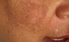 Hyperpigmentation: What It Is, Why It Happens, and the Different Forms