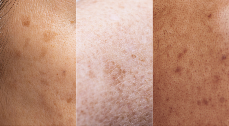Hyperpigmentation Part 2: How to Treat, Prevent, and Fade Dark Spots