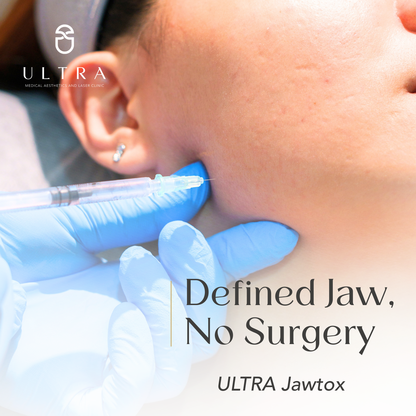 Close-up of a person receiving a cosmetic injection in their jaw area by a medical professional wearing gloves, with text overlay promoting ULTRA Jawtox for non-surgical jaw definition.