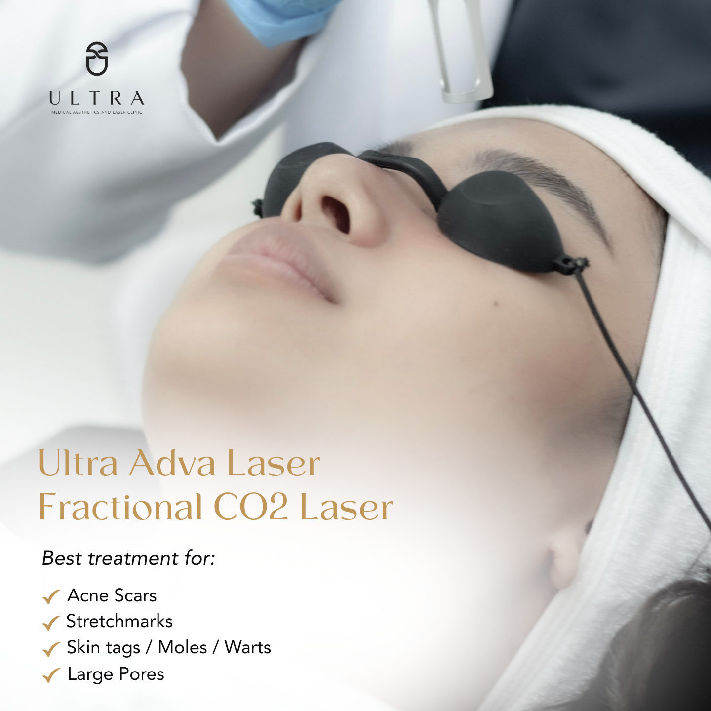 A woman lying down with protective eye shields during a laser treatment at a medical spa. She is wearing a white headband. The spa logo and text overlay advertise Ultra Adva Laser Fractional CO2 Laser treatments for acne scars, stretch marks, skin tags, moles, warts, and large pores.