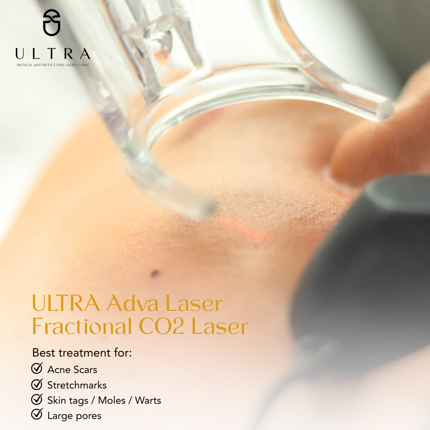 Close-up of a laser device in use on a person's skin, with text overlay describing ULTRA Adva Laser Fractional CO2 Laser and its benefits for acne scars, stretchmarks, skin tags, moles, warts, and large pores.