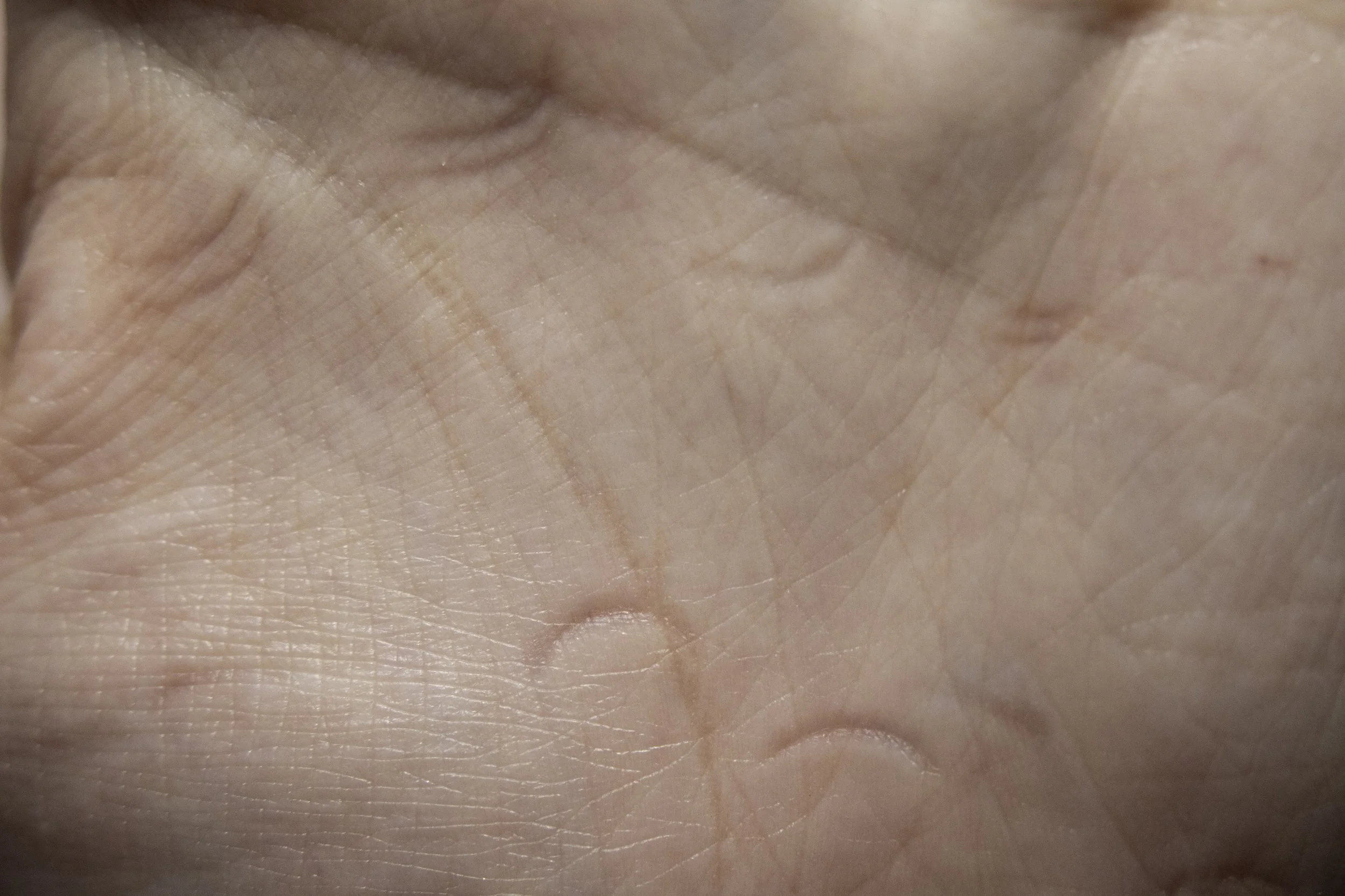 Close-up of the palm of a person's hand showing skin texture and lines, with nail marks across.