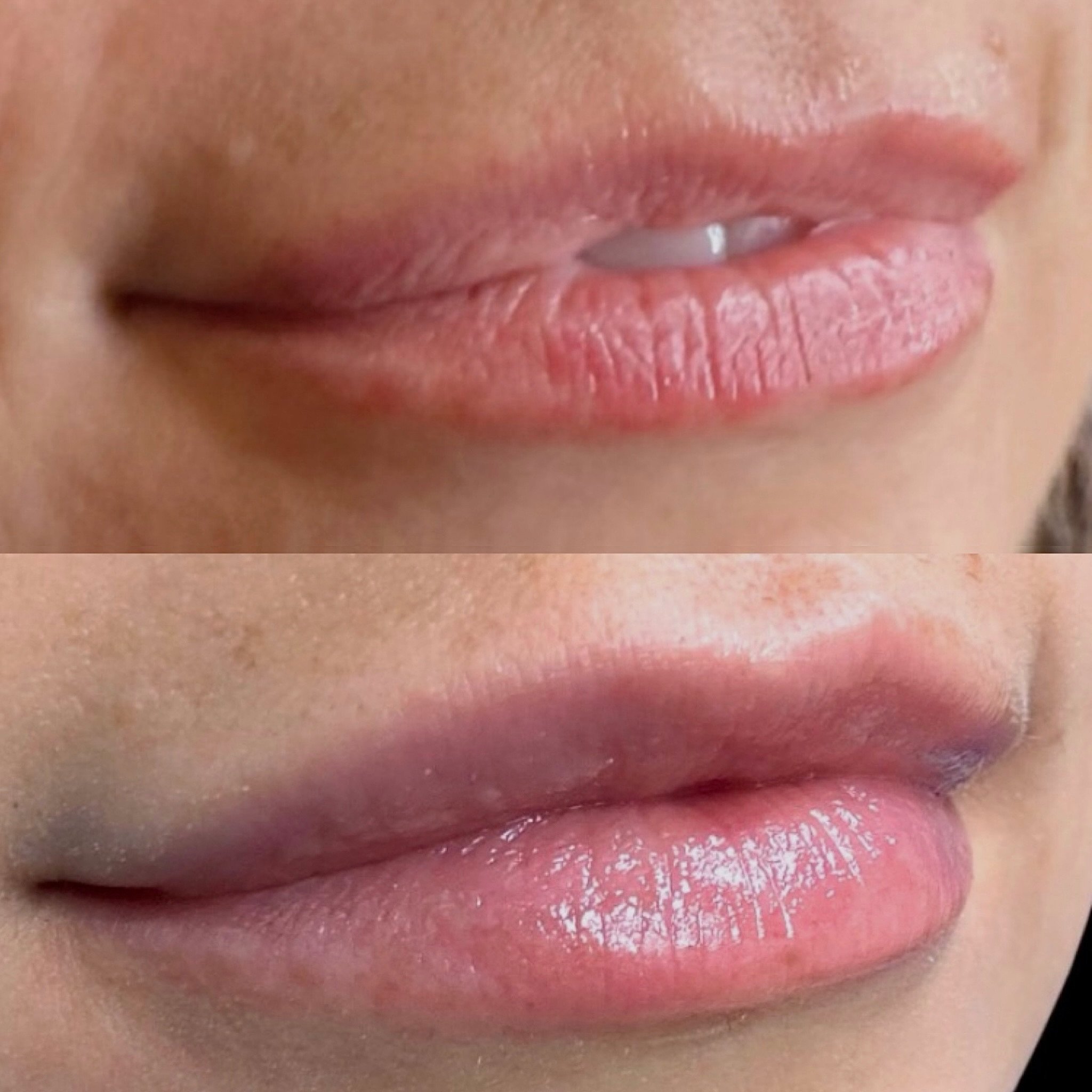 Patient A came in wanting a little more balance + symmetry while maintaining her natural lip shape.

With just &frac12; syringe of filler, Natalie focused on:
&bull; improving symmetry
&bull; restoring subtle upper-lip volume
&bull; enhancing definit