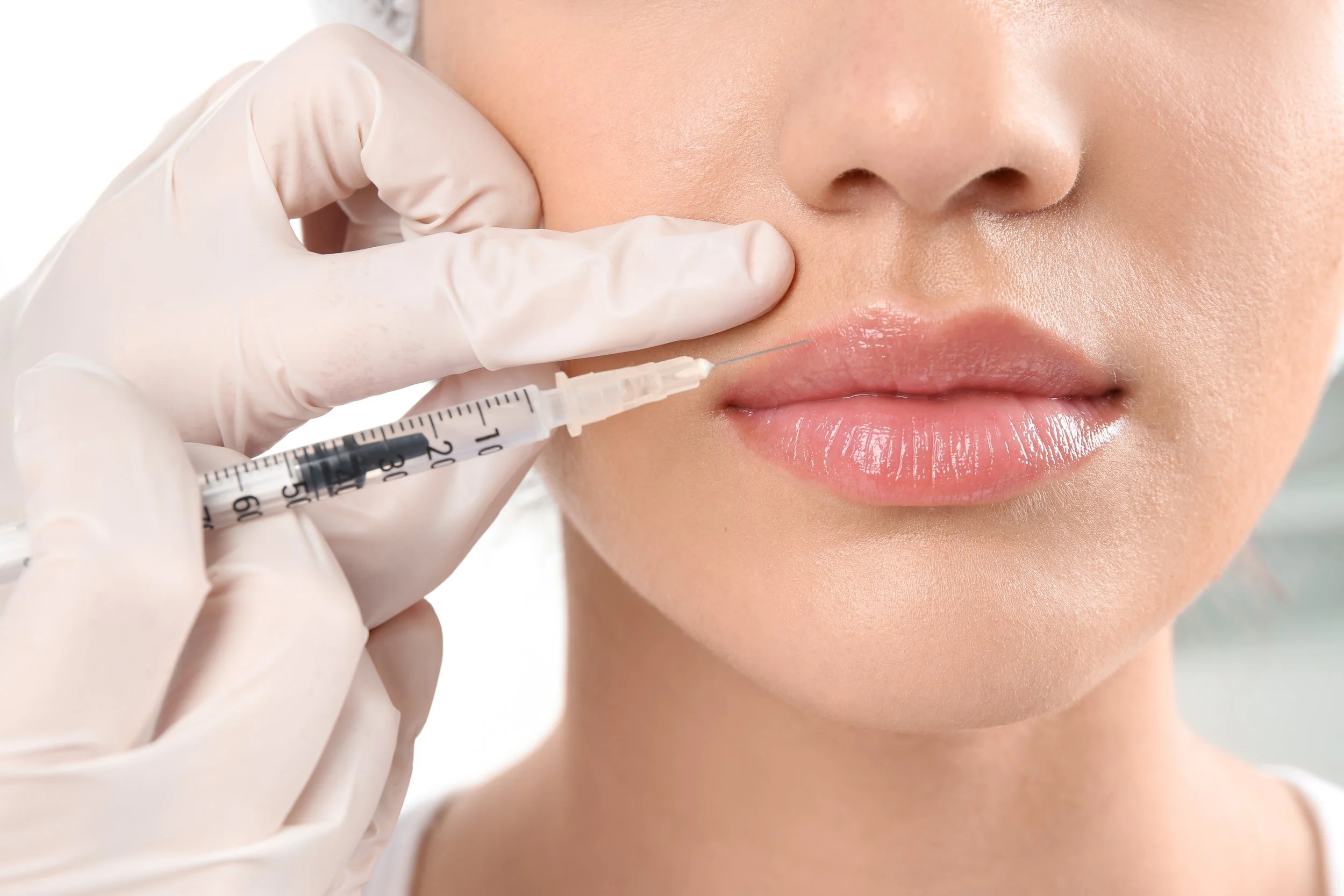 Filler (Restlylane, RHA, Juvederm)