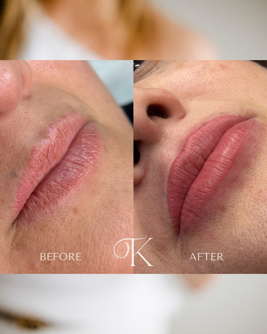 A beautiful lip blush transformation designed to enhance what was already there.
By adding soft colour, improving definition, and creating balance through the lip border, we were able to restore a youthful, healthy-looking appearance while keeping th