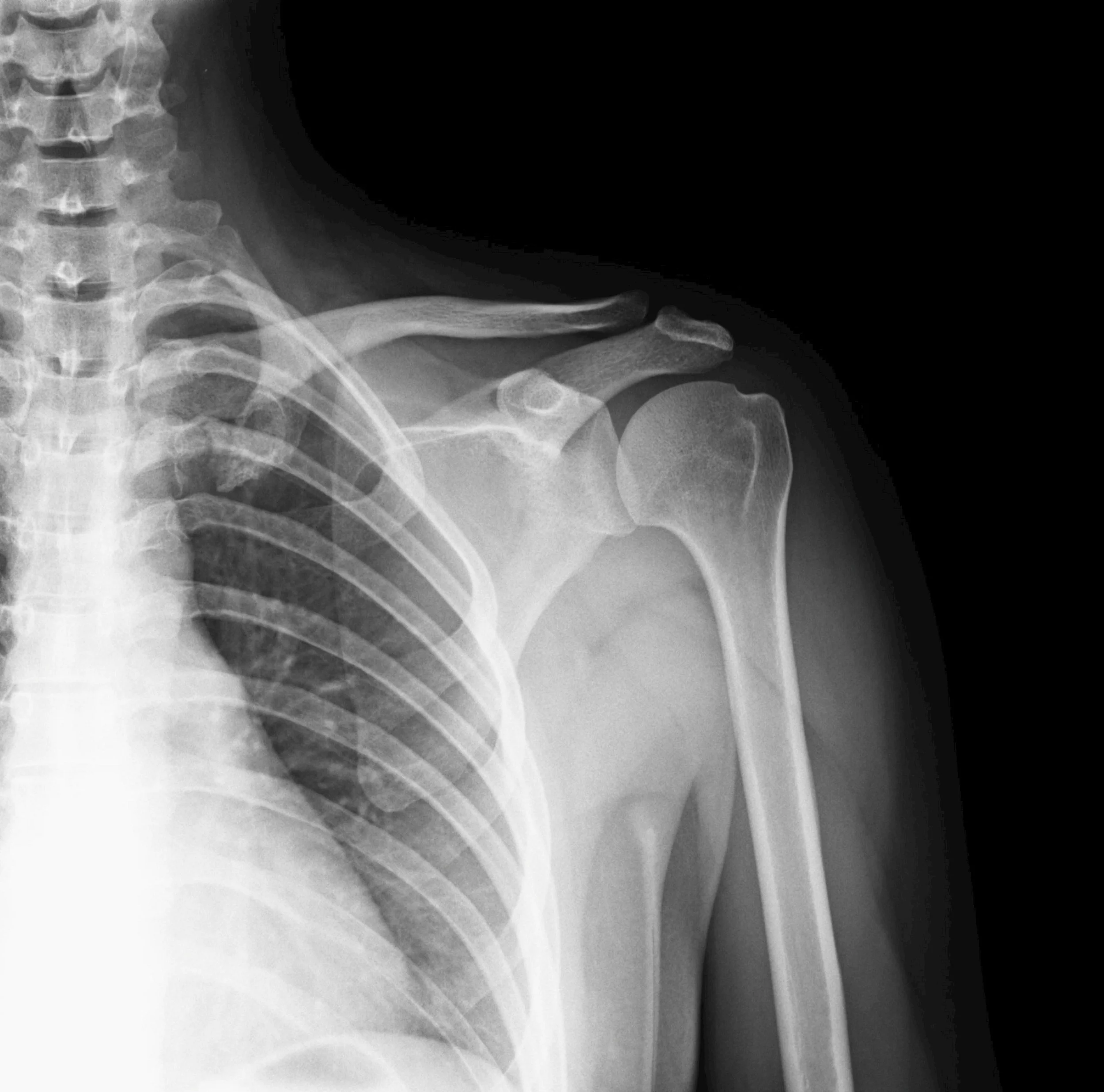X-ray image of the neck and shoulder showing cervical vertebrae and clavicle bones.