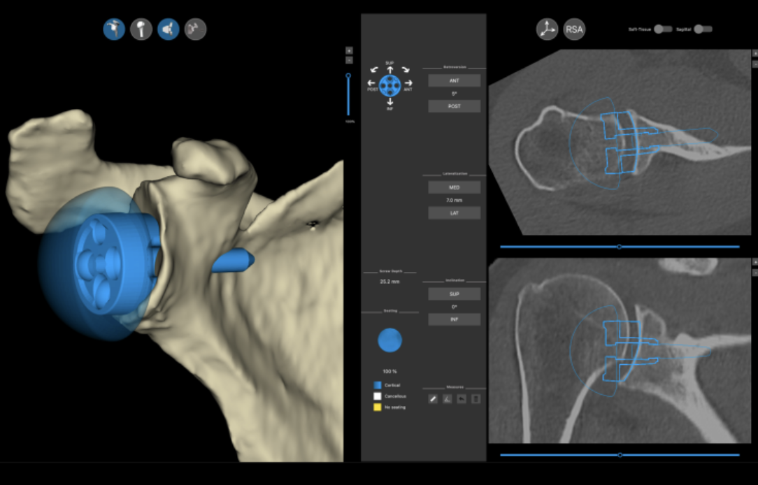 What is Shoulder Arthritis &amp; When Is The Time to Discuss Shoulder Replacement? 