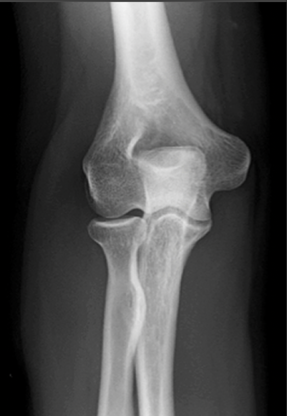 X-ray image of a human knee showing bones including the femur, tibia, fibula, and the kneecap.