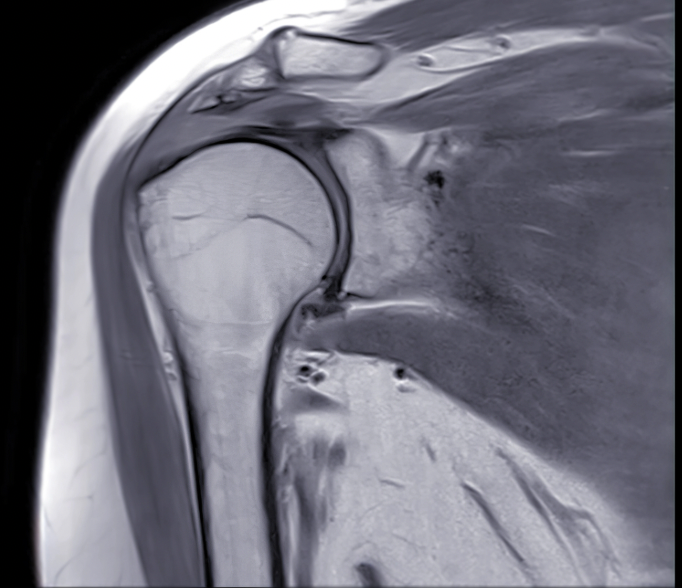 MRI scan of a human knee joint showing bones, cartilage, and soft tissue.
