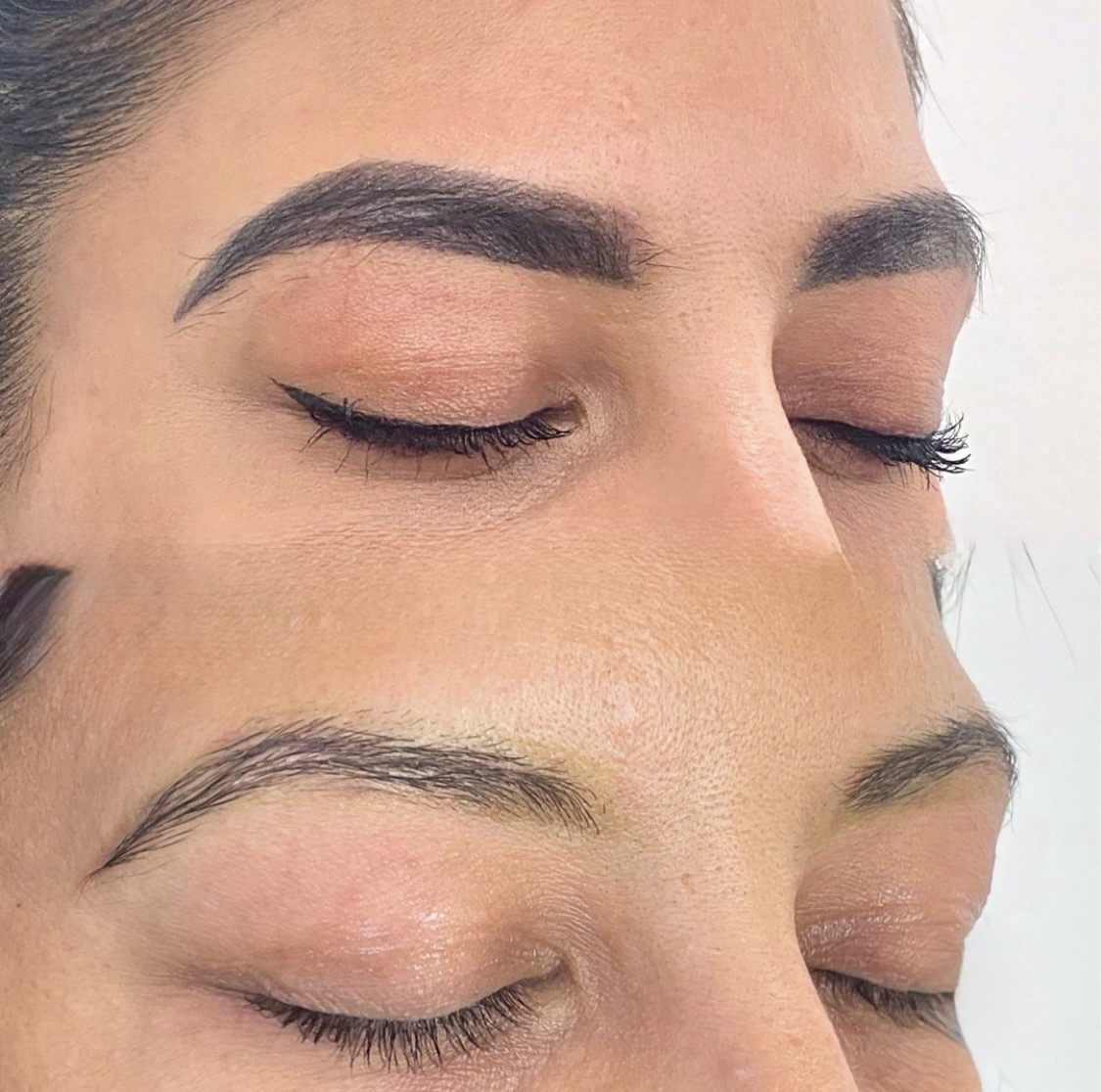 Permanent makeup removal improving brow color and reducing unwanted pigment