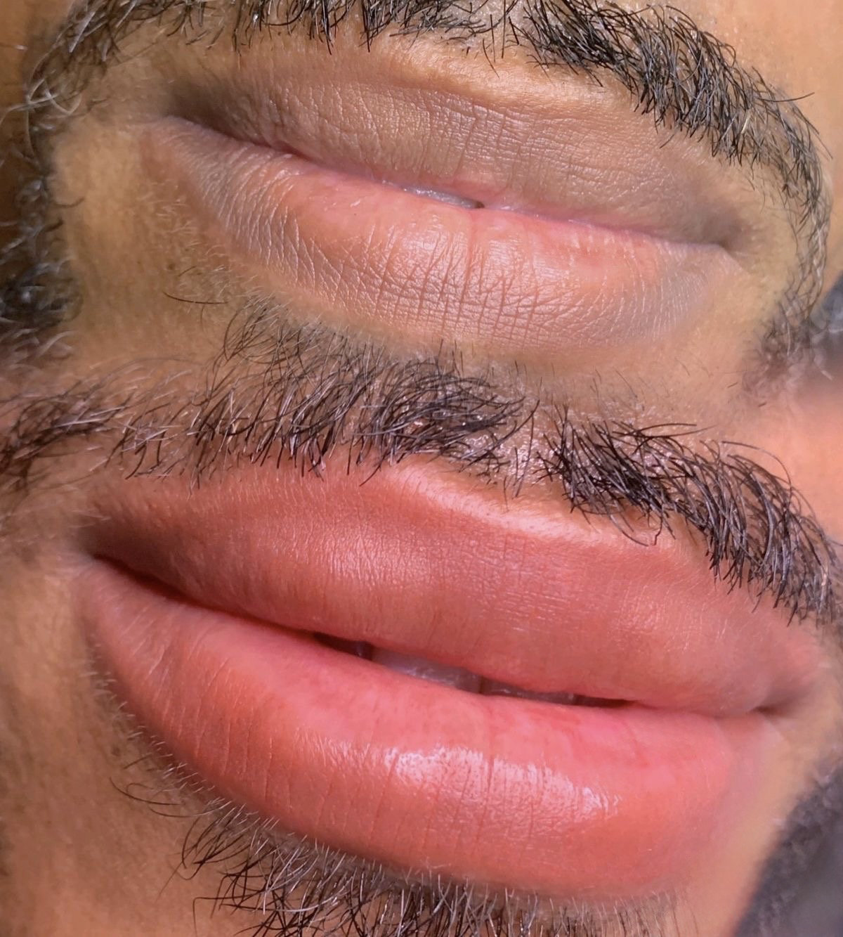 Male lip neutralization before and after correcting dark lip pigmentation to a softer natural tone