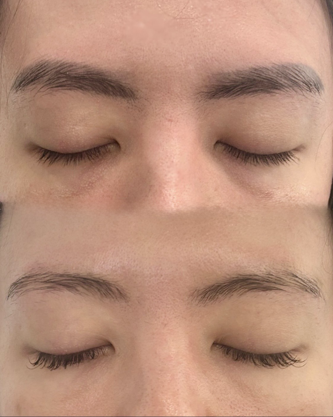 Eyebrow tattoo removal results showing gradual correction of old pigment