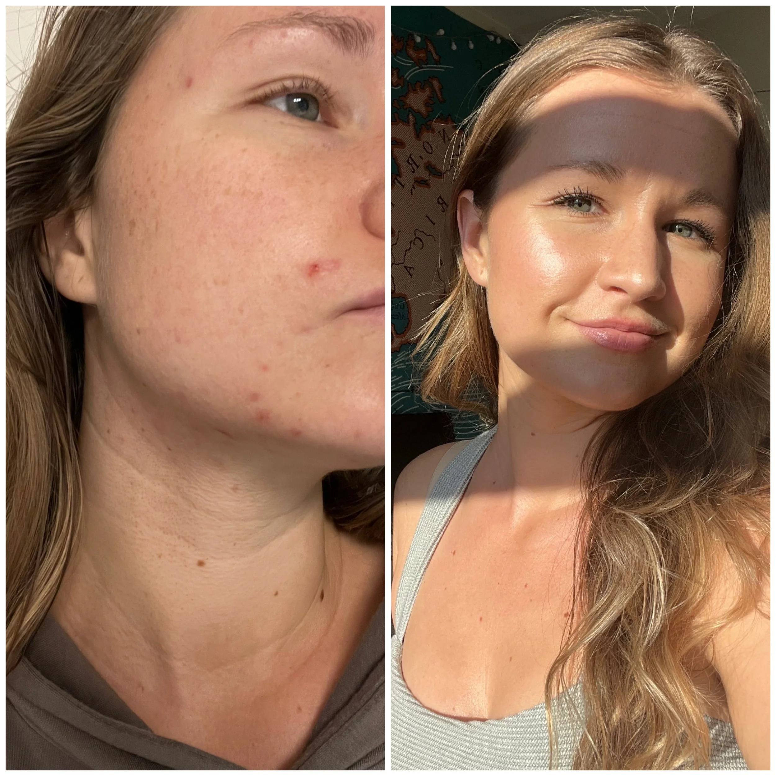 Side-by-side comparison photo showing one woman with skin blemishes and acne on the left and the same woman with clear, glowing skin on the right, enjoying sunlight.