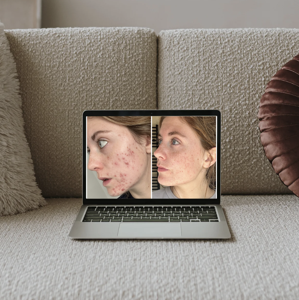 Root Cause Acne Approach. Science based approach to improving your acne from the inside out. Functional lab testing provides answers to your symptoms to clear your acne and improve your gut health.