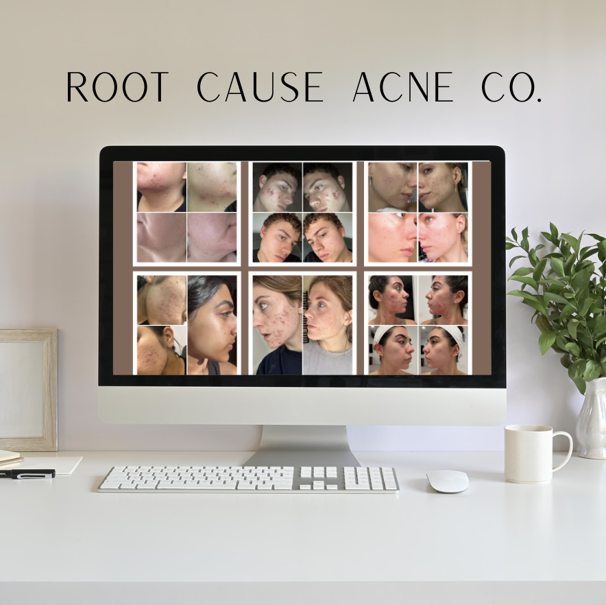 Computer screen displaying before-and-after photos of individuals with acne, with the name 'Root Cause Acne Co.' at the top.