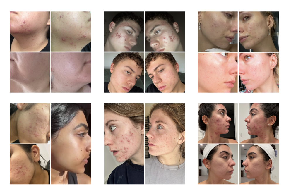 Before and after acne photos