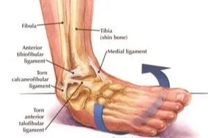 The Challenges I Faced Before Surgery: Chronic Pain, Instability, and Working Through an Undiagnosed Injury