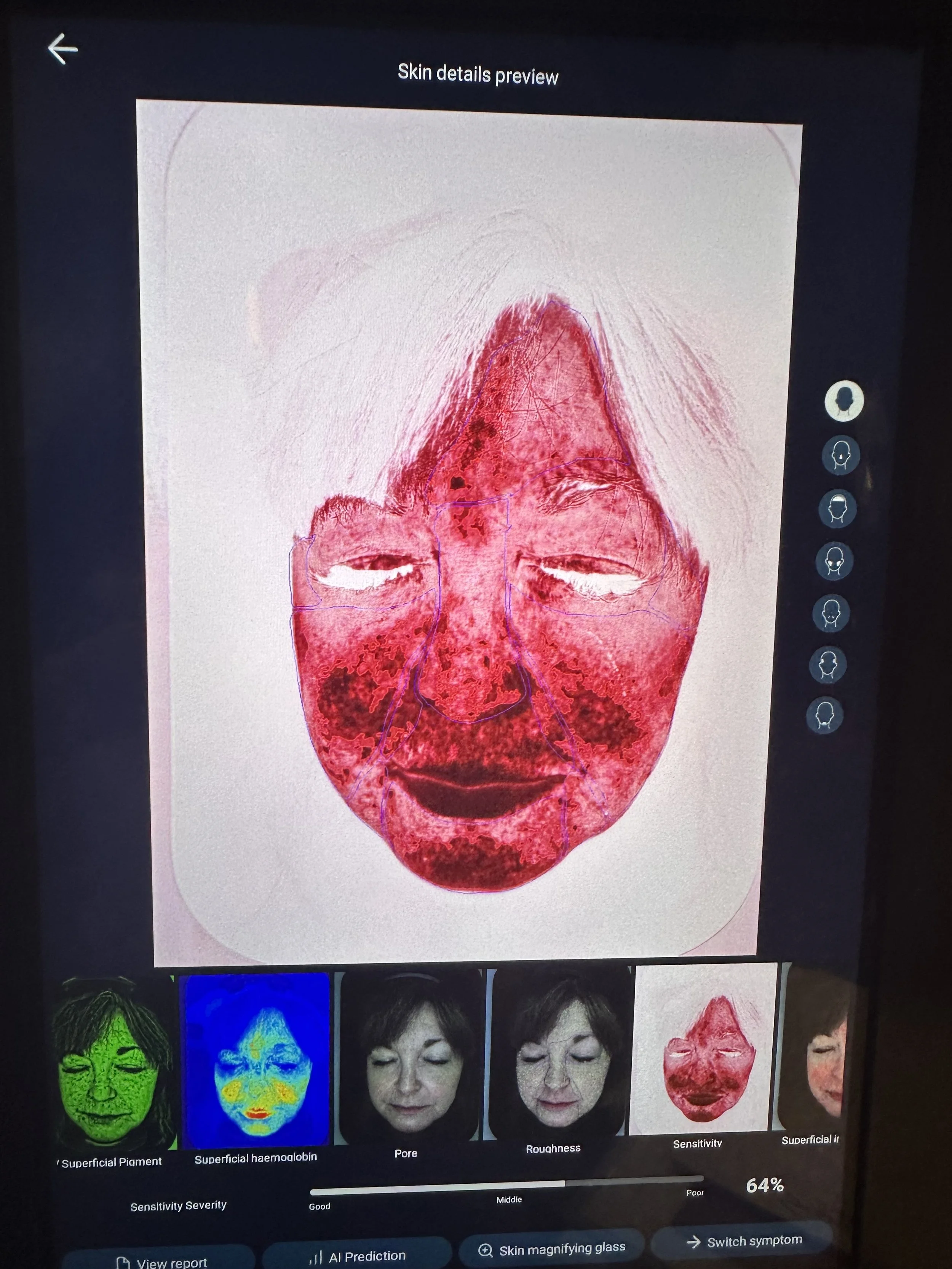 At Pearl Cove Aesthetics, digital screen displaying a skin analysis report with a color-coded face map showing various skin conditions, such as superficial pigment, superficial hemoglobin, pores, roughness, sensitivity, and surface irregularities.