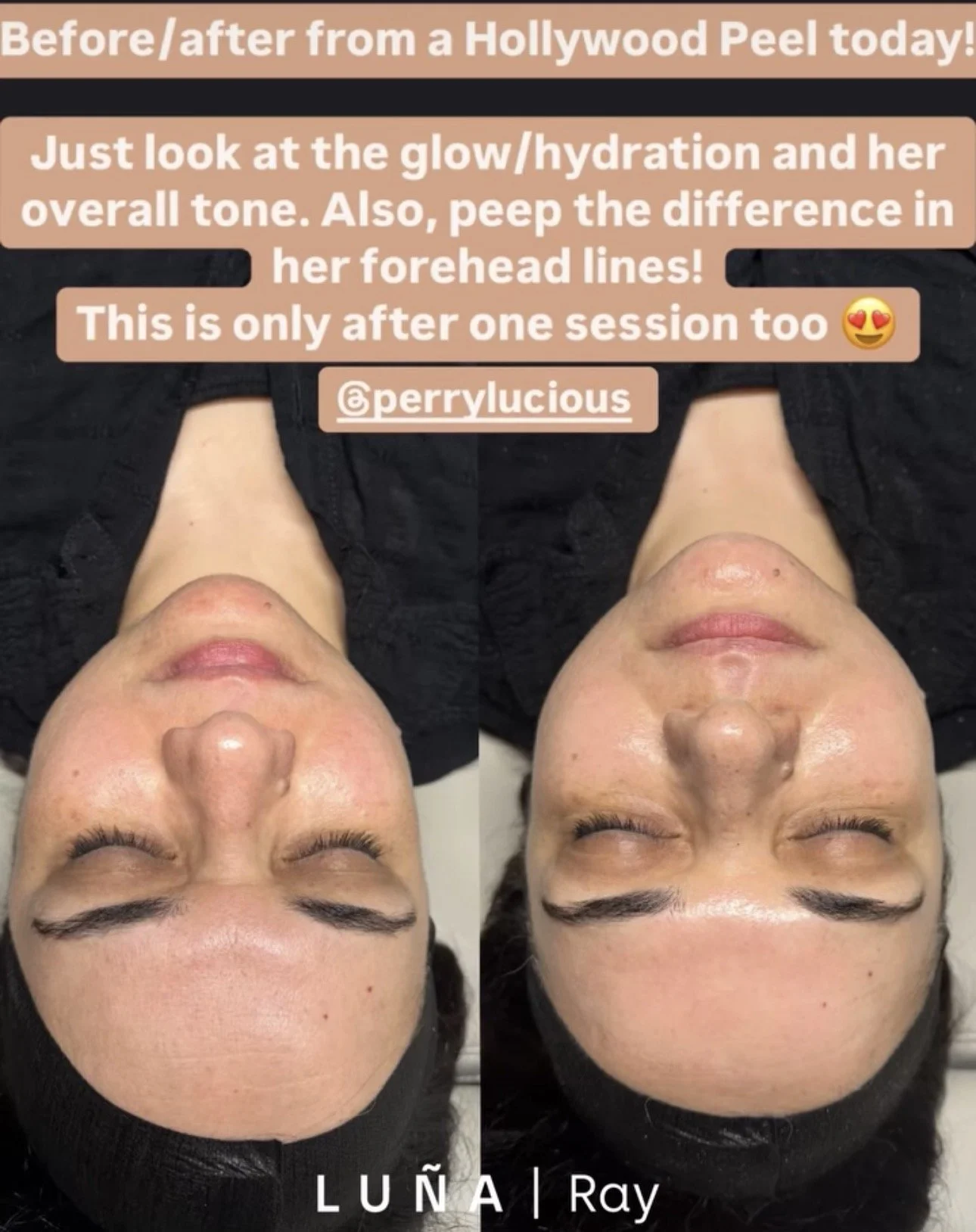 Side-by-side comparison of a woman’s face before and after a skincare or facial treatment. The left image shows her forehead with some redness, and the right image shows her forehead looking smoother and clearer. The woman has dark hair and is lying back with her eyes closed in both photos. The text overlay discusses the effects of a Hollywood peel, mentioning glow, hydration, and tone improvements after one session.