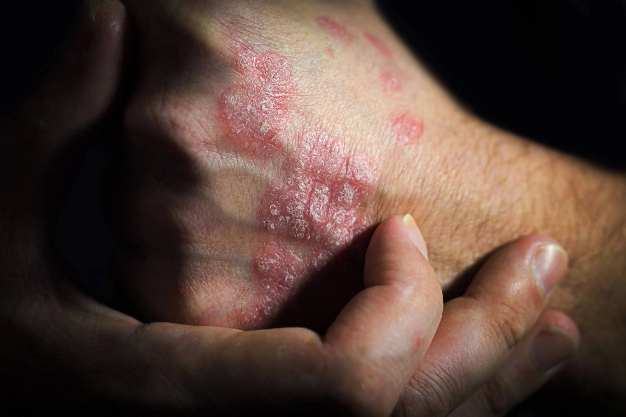 Psoriatic Arthritis