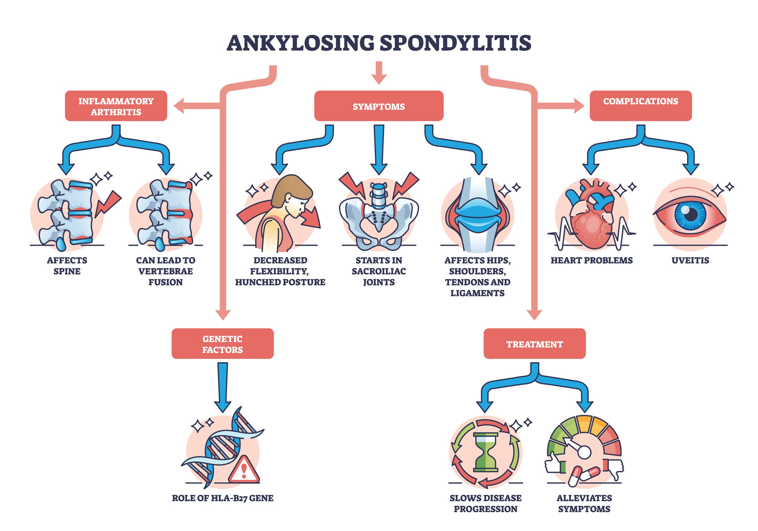 Ankylosing Spondylitis