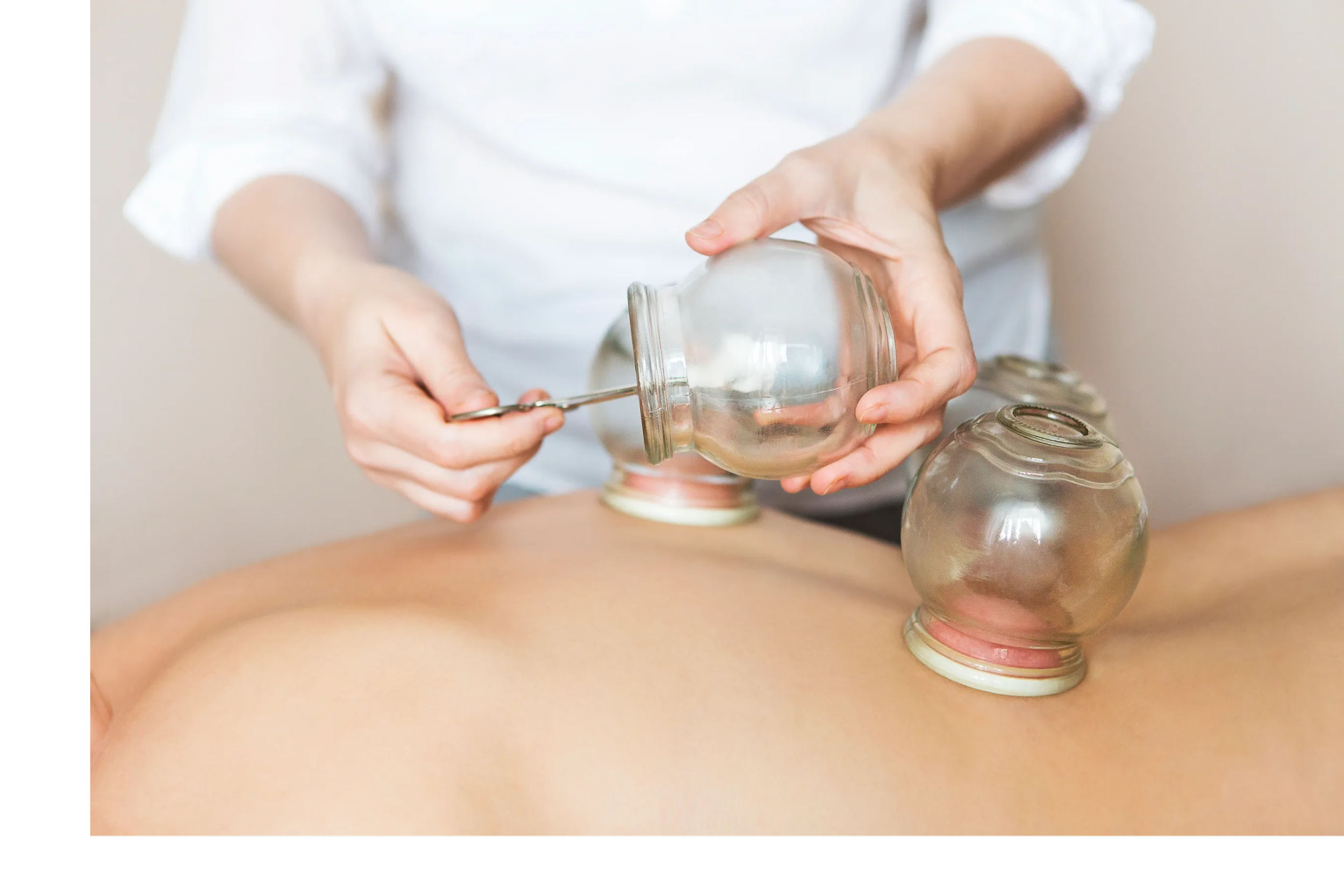 A person performing cupping therapy on someone's back using glass cups.
