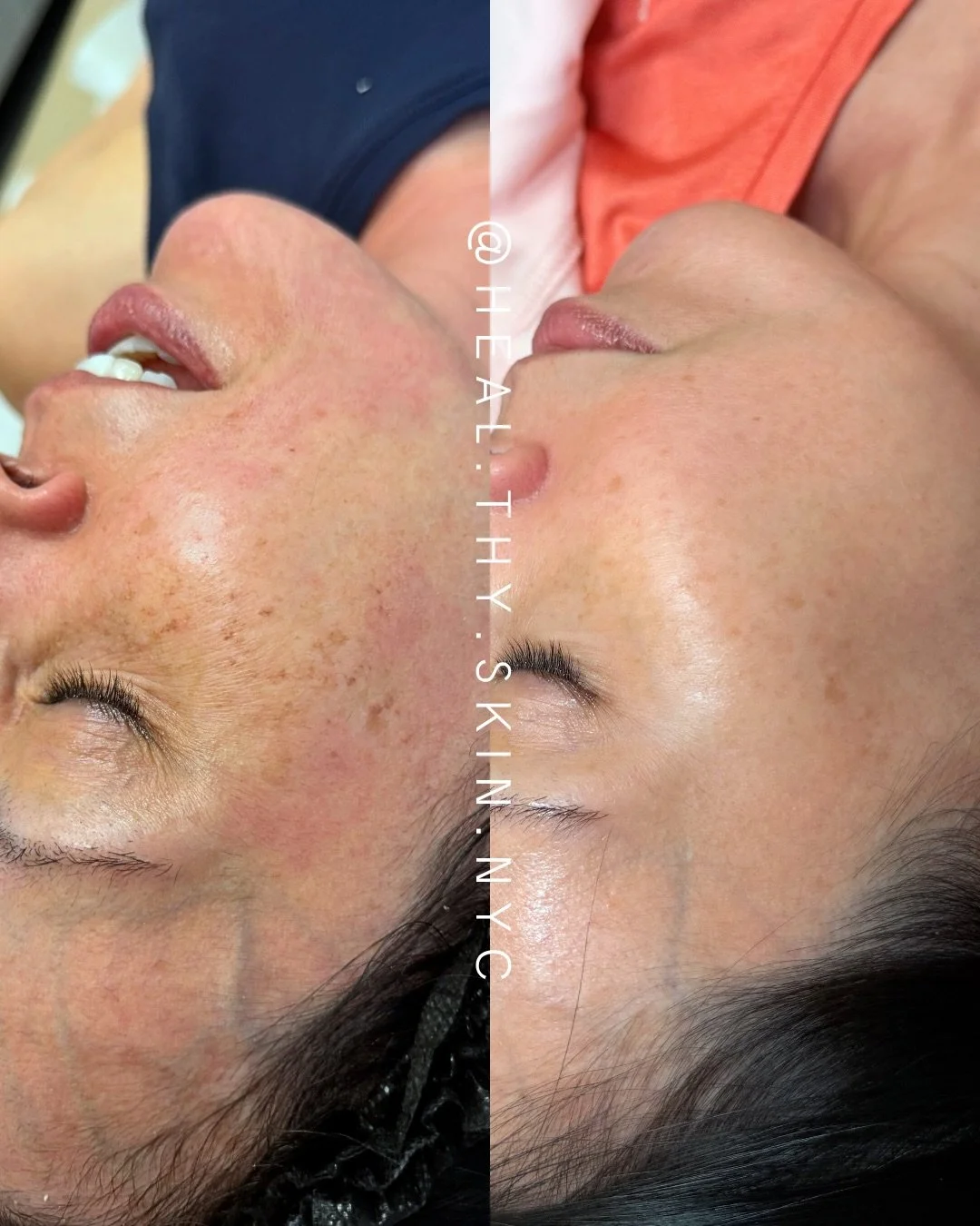 One session of BBL + Moxi can significantly improve the appearance of dark spots by targeting excess pigment in the skin through two complementary technologies. BBL (BroadBand Light) uses light energy to break up unwanted pigmentation caused by sun d