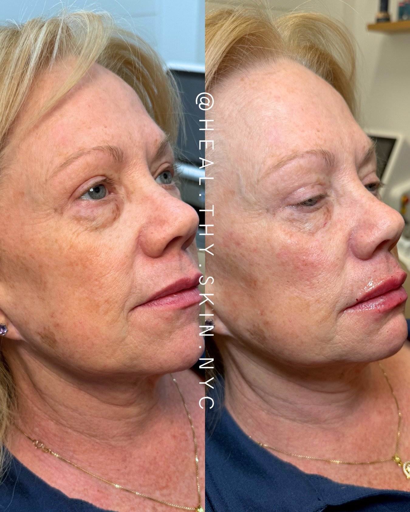 Some facial balancing refresh✨

To book an appointment or for a free consult: DM or email @ heal.thy.skin.nyc1@gmail.com! Shop online or in our app to purchase products &amp; services. Link in bio!

#facailbalancing #injector #aestheticnurse
