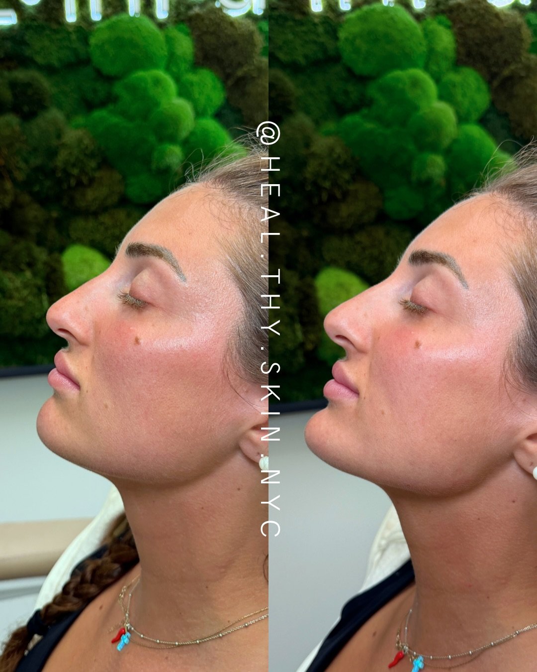 Just obsessed with chin enhancement treatments because of how subtle yet impactful the result can be. A small amount of structure in the chin can bring more balance to the entire face, helping define the profile, support the lower face, and create a 