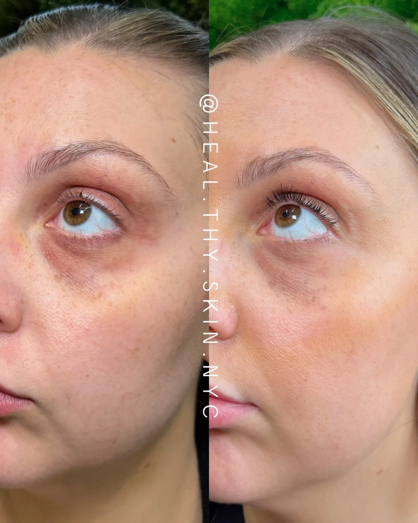After just 1 EZ gel session for dark under eyes✨

EZ Gel helps brighten the under-eyes by stimulating collagen and improving overall skin quality in one of the thinnest areas of the face. By thickening and hydrating the skin over time, it can reduce 
