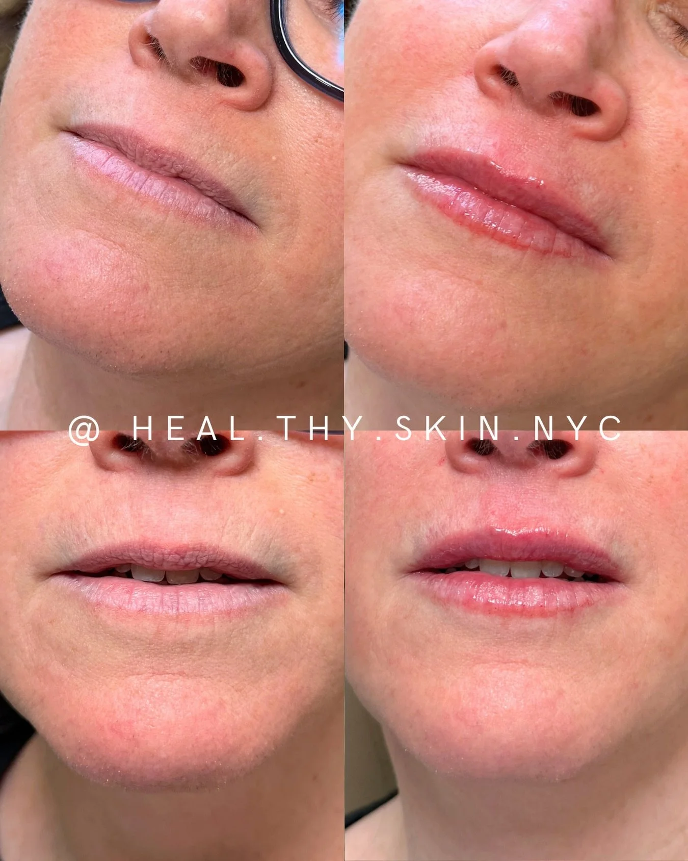 This clients request: &ldquo;I want a top lip again&rdquo; 
When restoring volume to the top lip, it&rsquo;s not just about adding shape  it&rsquo;s also about supporting the tissue around the mouth. By strategically treating the perioral area, we ca