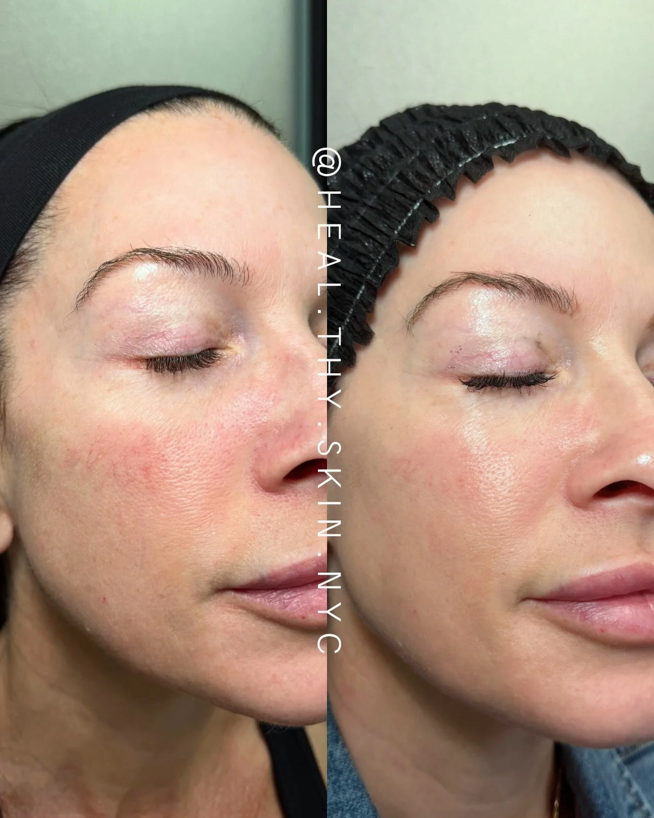 BBL + Moxi is an excellent combination for redness / vessels / rosacea  because it treats both redness and skin quality. BBL targets flushing and visible vessels, while Moxi helps strengthen the skin barrier, improve texture, and reduce inflammation-