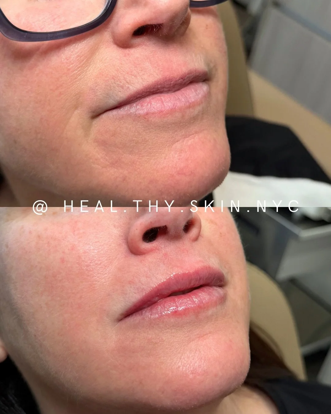 Beautiful lips aren&rsquo;t always created in a single appointment. Often, the best results come from building volume gradually over multiple sessions. This approach allows for precise adjustments, maintains natural proportions, and gives the filler 