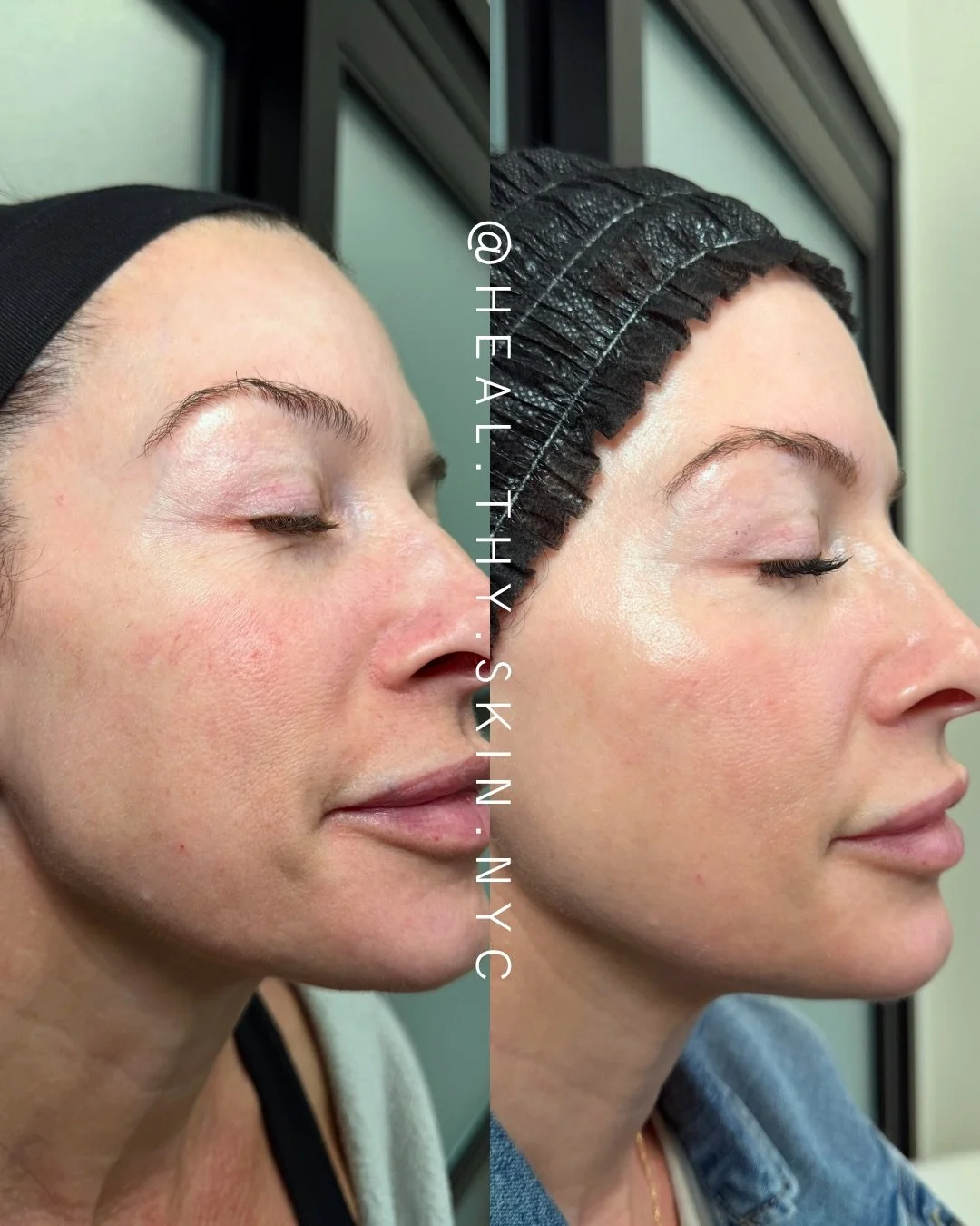 BBL and MOXI work together to address multiple skin concerns in a single treatment plan. BBL targets unwanted redness and visible blood vessels, especially around the cheeks and nose, while also helping improve overall skin tone. MOXI focuses on skin