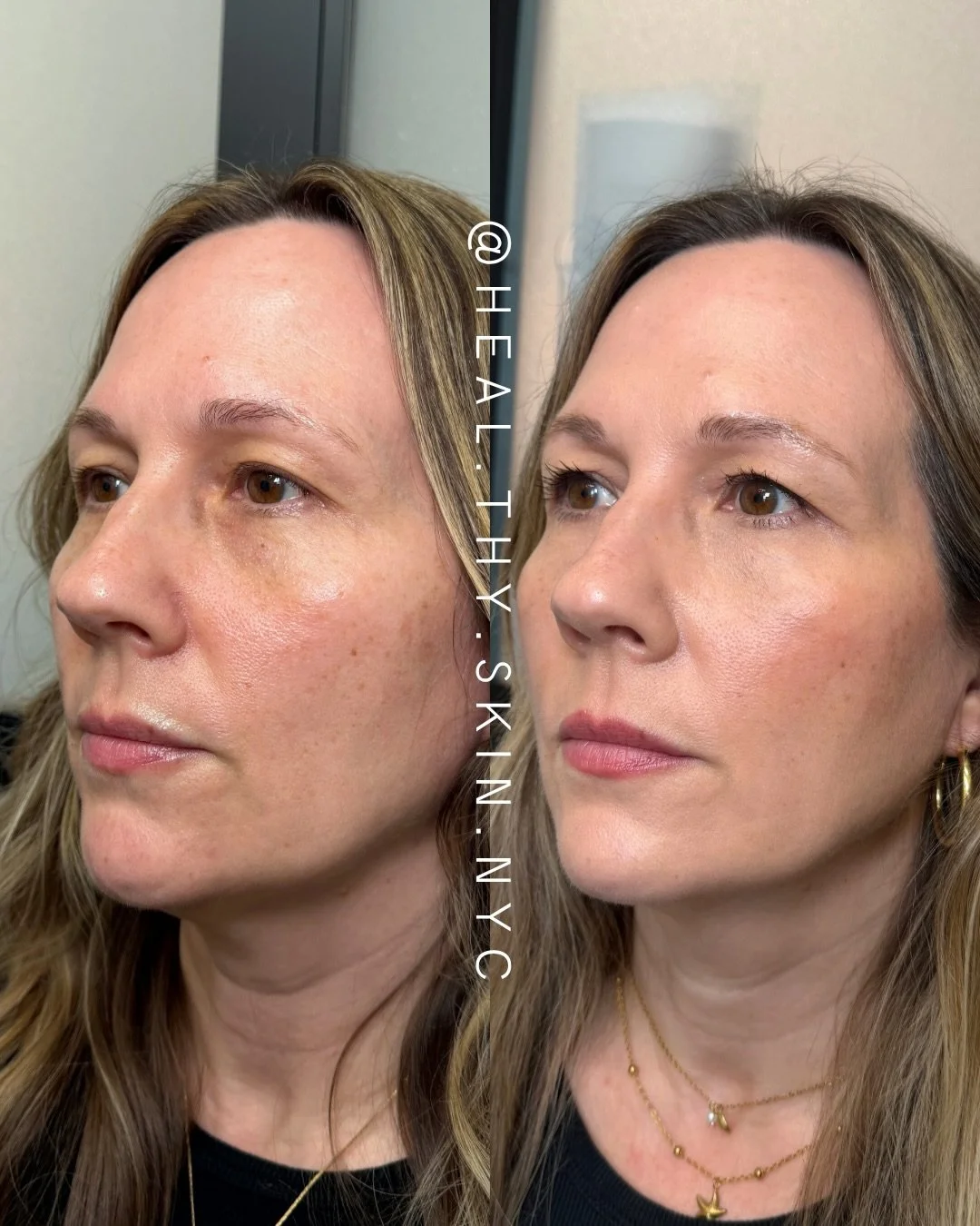 &ldquo;I just want a little lift&rdquo; is one of the most requested concerns I hear when clients come in for facial balancing. Using a combination of filler, tox, and EZ Gel, we focused on restoring support and creating subtle, natural-looking balan