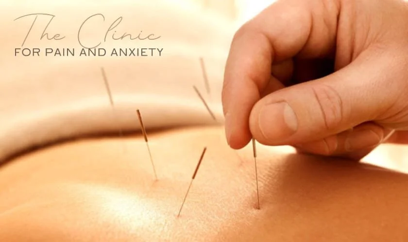 5 Benefits Of Acupuncture