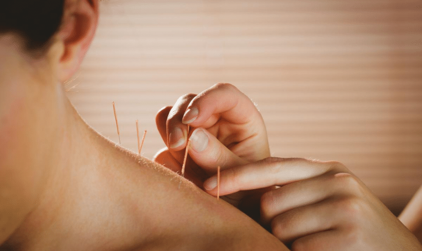 5 common myths about acupuncture
