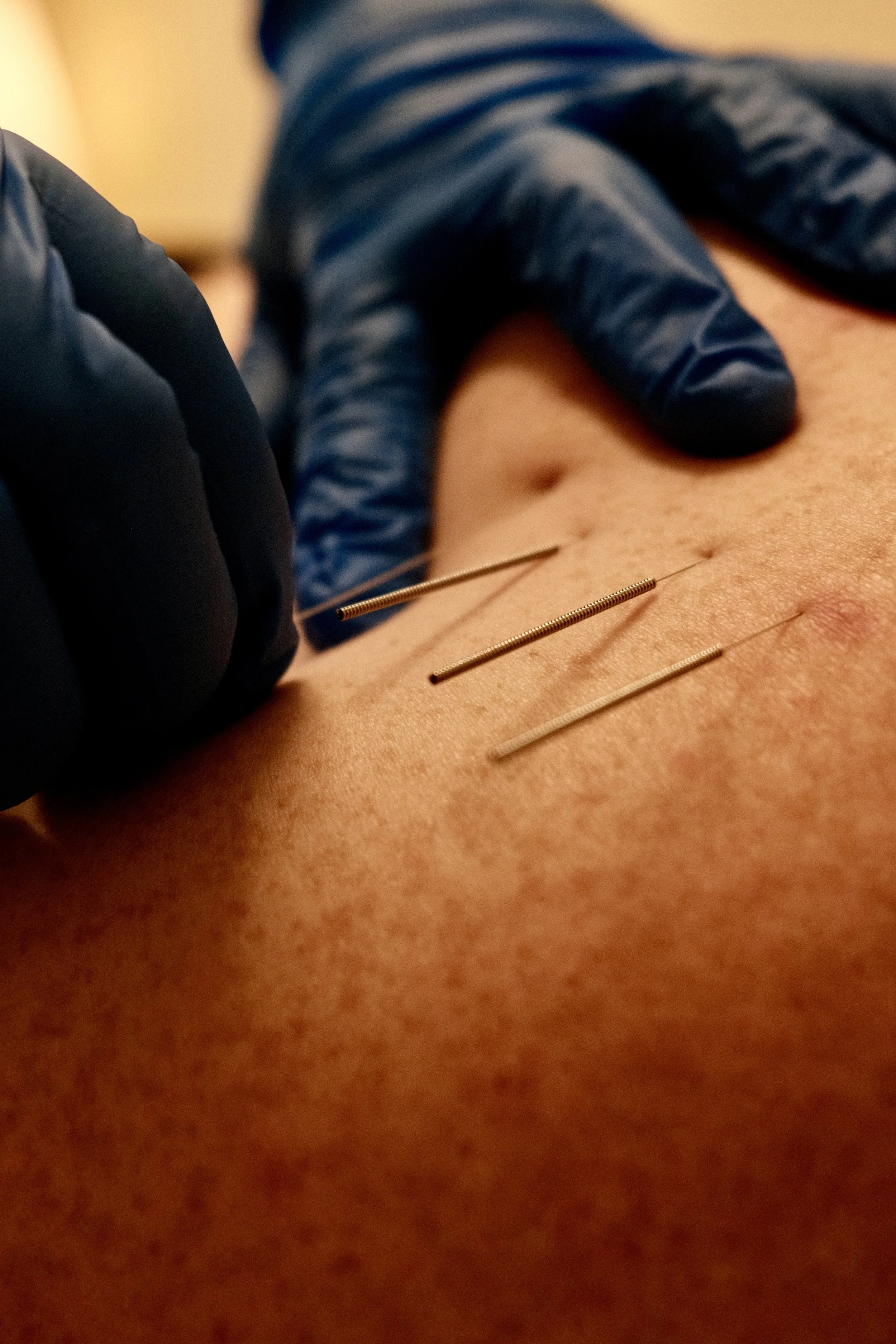 Functional Dry Needling: Myths, Benefits and What to Expect