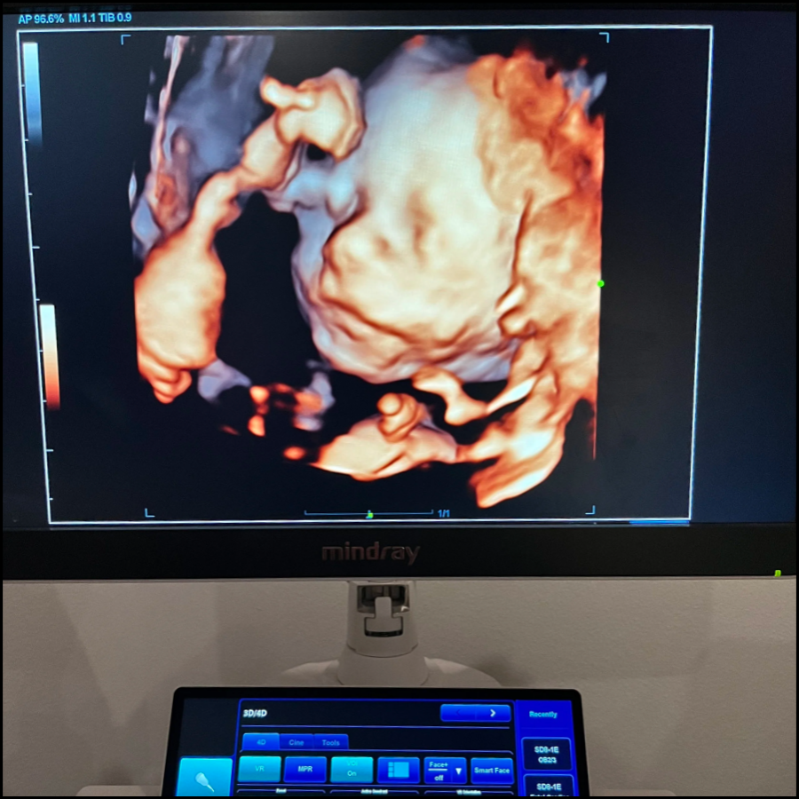 A 3D ultrasound image of a fetus in the womb, showing detailed facial features and limbs.