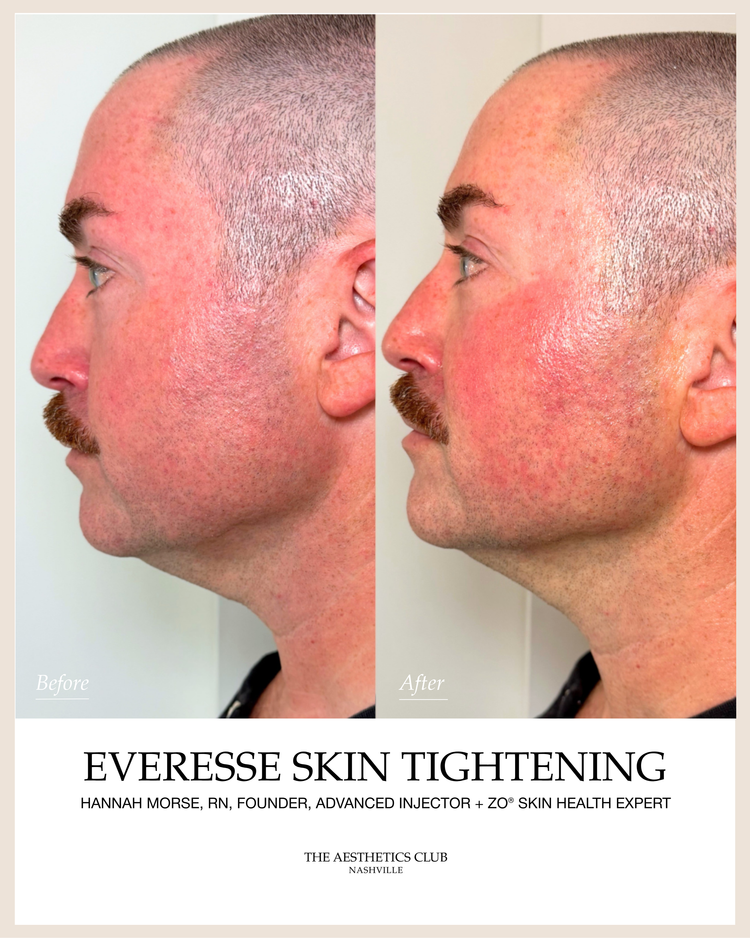 Non surgical skin tightening Nashville result