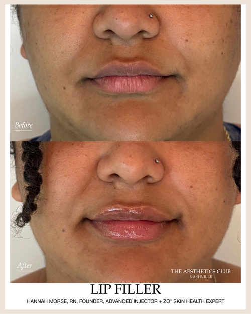 Natural-Looking Lip Filler before and after by Hannah Morse Cuffman RN